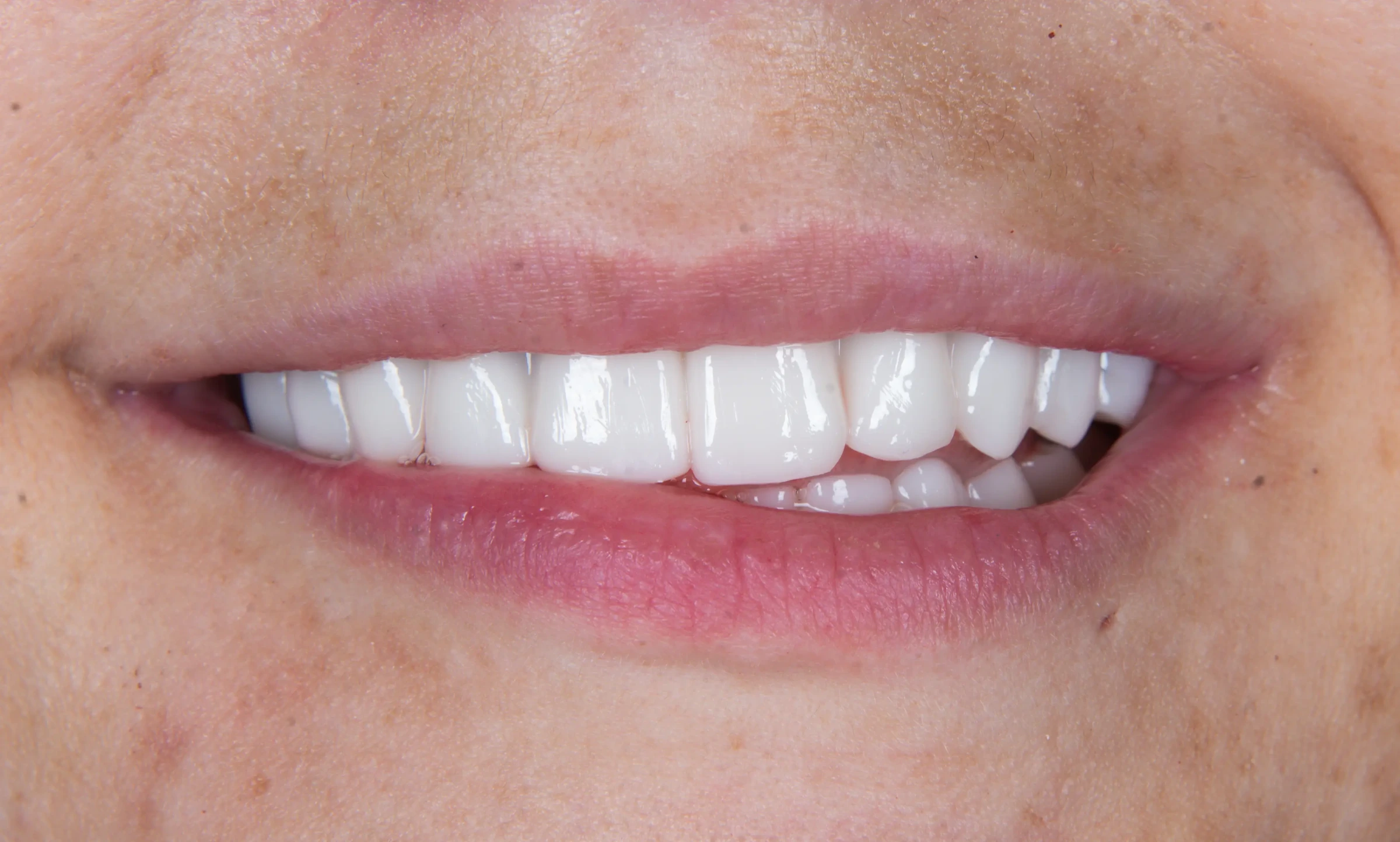 Close-up of a natural implant-restored smile at Destin Implant and Smile Studio